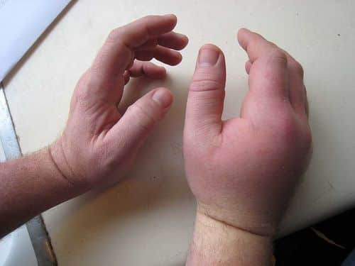 effetti di una puntura calabrone su una mano che si è gonfiata